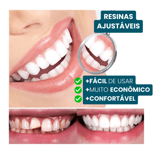 SmileWhite  - Par de Facetas Dentárias Naturais (MOLDE AJUSTÁVEL!)