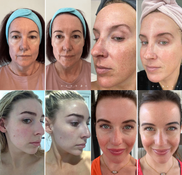 BiocollagenPlus - Máscara absorvível de colágeno + ativos do botox